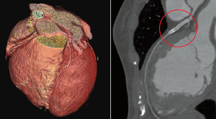 CT coronary artery calcium scoring